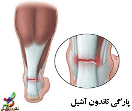 Achilles tendon rupture elmevarzesh