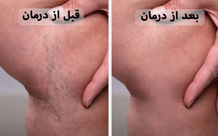 واریس را با یک تزریق ساده درمان کنید! 5 قبل و بعد از درمان واریس عنکبوتی ساق پا