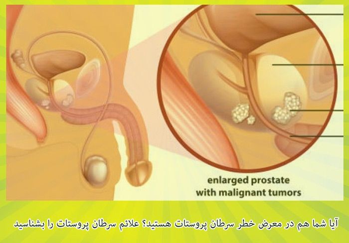 سرطان پروستات