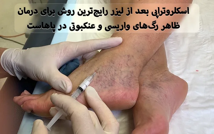 واریس را با یک تزریق ساده درمان کنید! 4 اسکلروتراپی واریس مچ پا